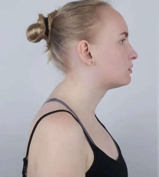 Neck posture before using the VivoSleep traction device